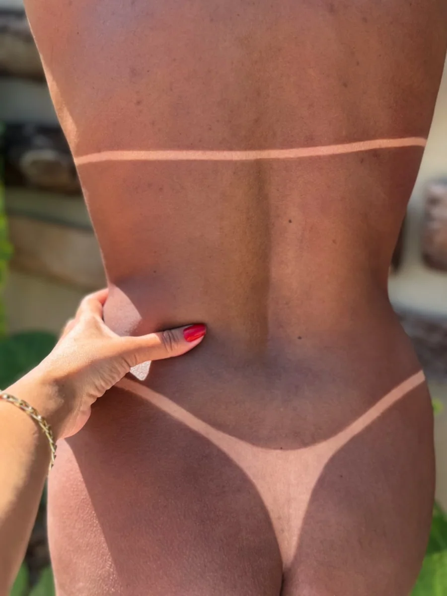 Resultado de bronzeamento com marca nas costas